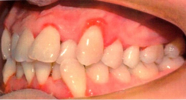 Invisalign case 3 before treatment