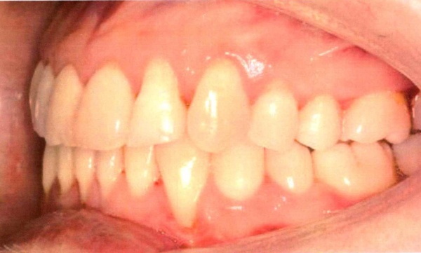 Invisalign case 3 after treatment