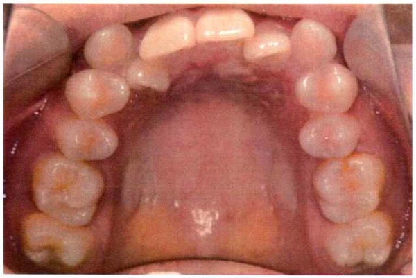 Invisalign case 1, upper arch before treatment