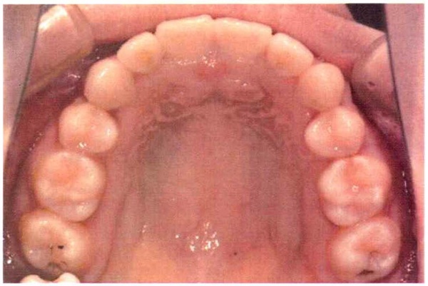 Invisalign case 1, upper arch after treatment