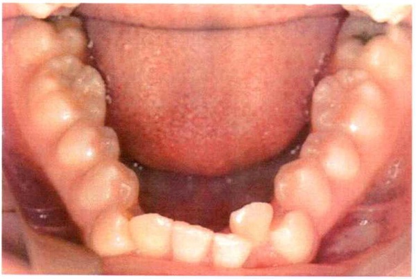 Invisalign case 1, lower arch before treatment