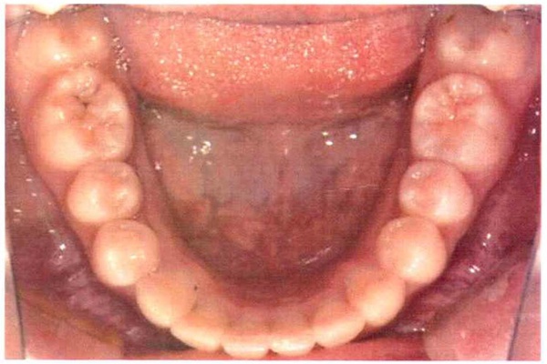 Invisalign case 1, lower arch after treatment
