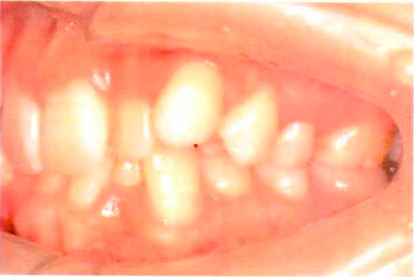 Invisalign case 1, side view before treatment