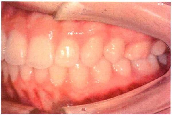 Invisalign case 1, side view after treatment