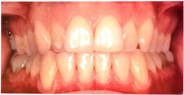 Invisalign case 2 before treatment