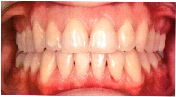 Invisalign case 2 after treatment
