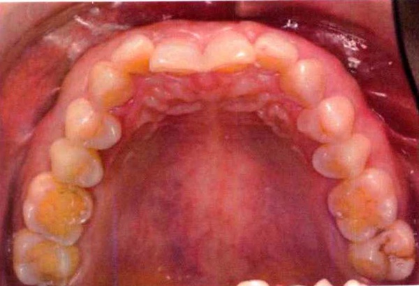 Invisalign case 6, upper arch before treatment