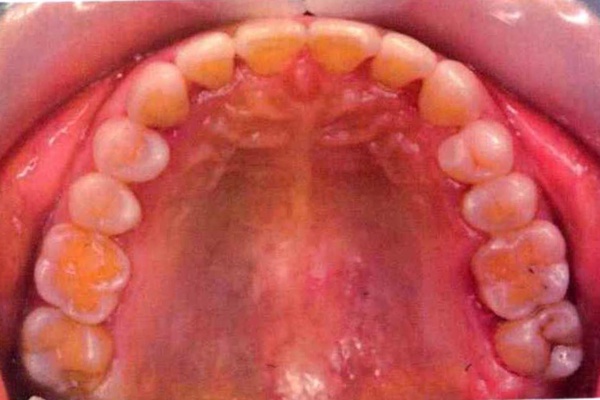 Invisalign case 6, upper arch after treatment