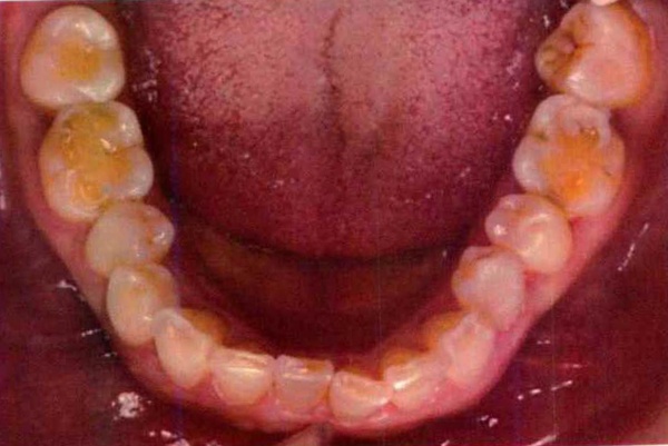 Invisalign case 6, lower arch before treatment