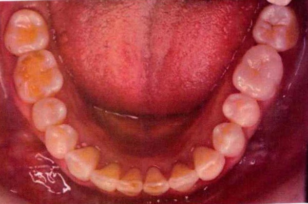 Invisalign case 6, lower arch after treatment