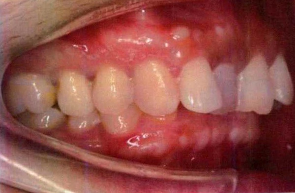 Invisalign case 6, side view before treatment
