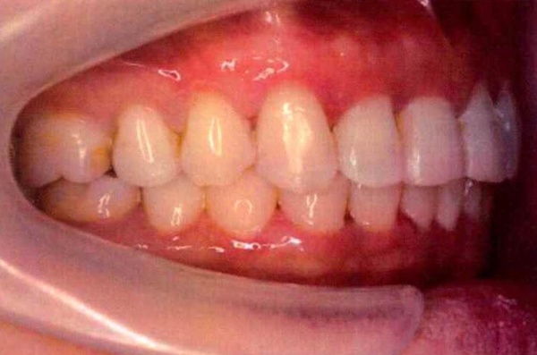 Invisalign case 6, side view after treatment