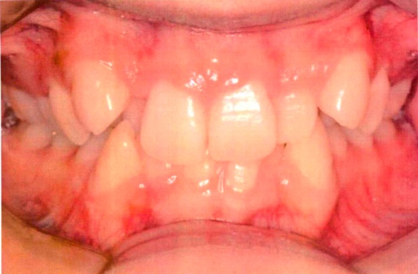 Invisalign case 4 before treatment