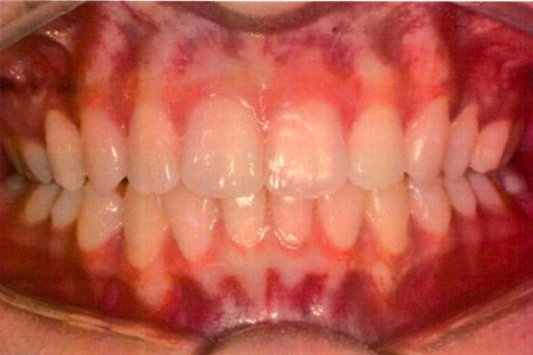 Invisalign case 4 after treatment