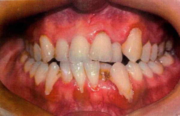 Invisalign case 10 before treatment