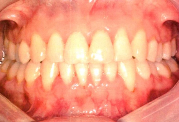 Invisalign case 10 after treatment