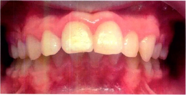 Invisalign case 7 before treatment
