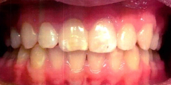 Invisalign case 7 after treatment