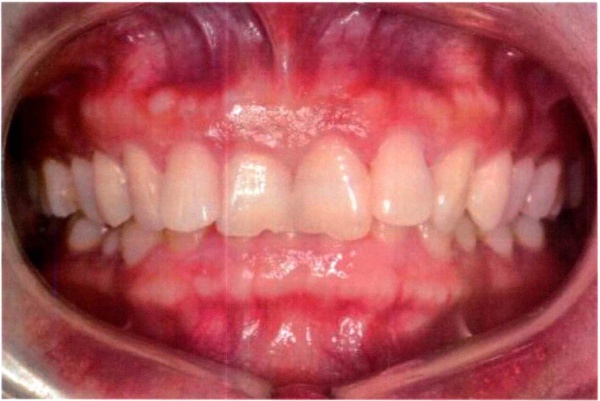 Invisalign case 9 before treatment