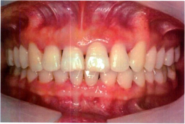Invisalign case 9 after treatment