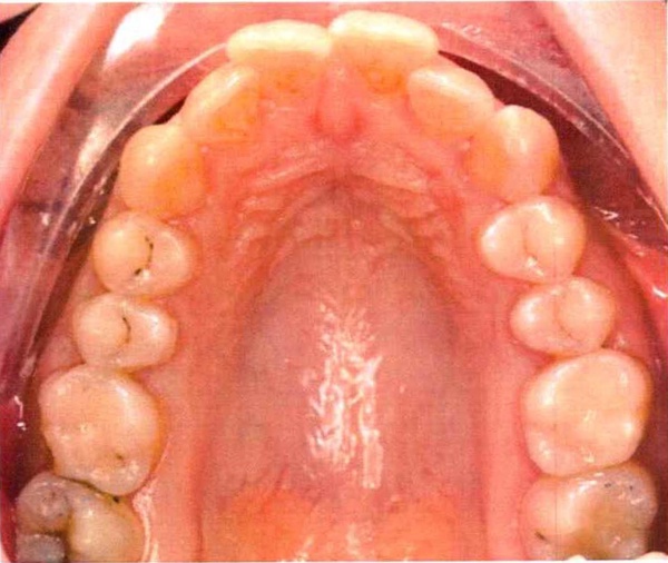 Invisalign case 8, upper arch before treatment