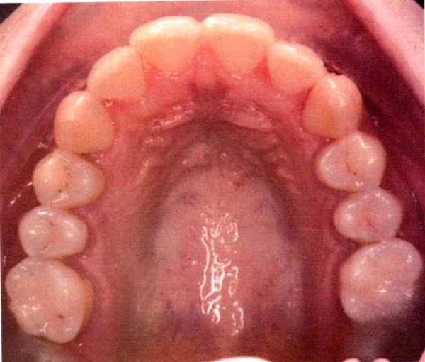 Invisalign case 8, upper arch after treatment