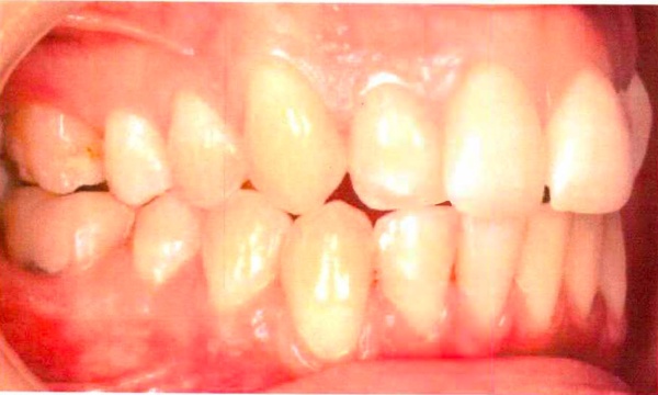 Invisalign case 8, side view before treatment