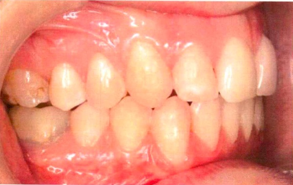 Invisalign case 8, side view after treatment