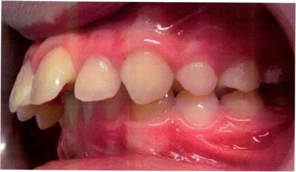 Invisalign case 5 before treatment