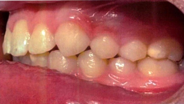 Invisalign case 5 after treatment