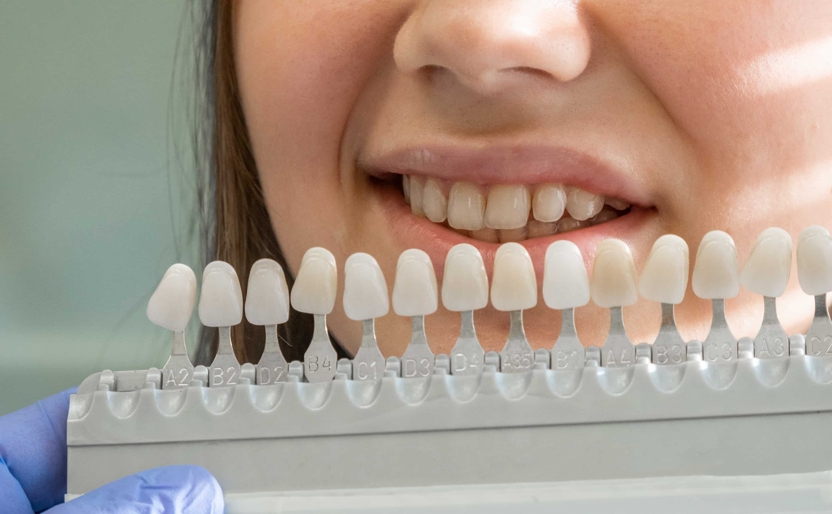 Veneers vs. Crowns vs. Bonding: A New Smile by New Year