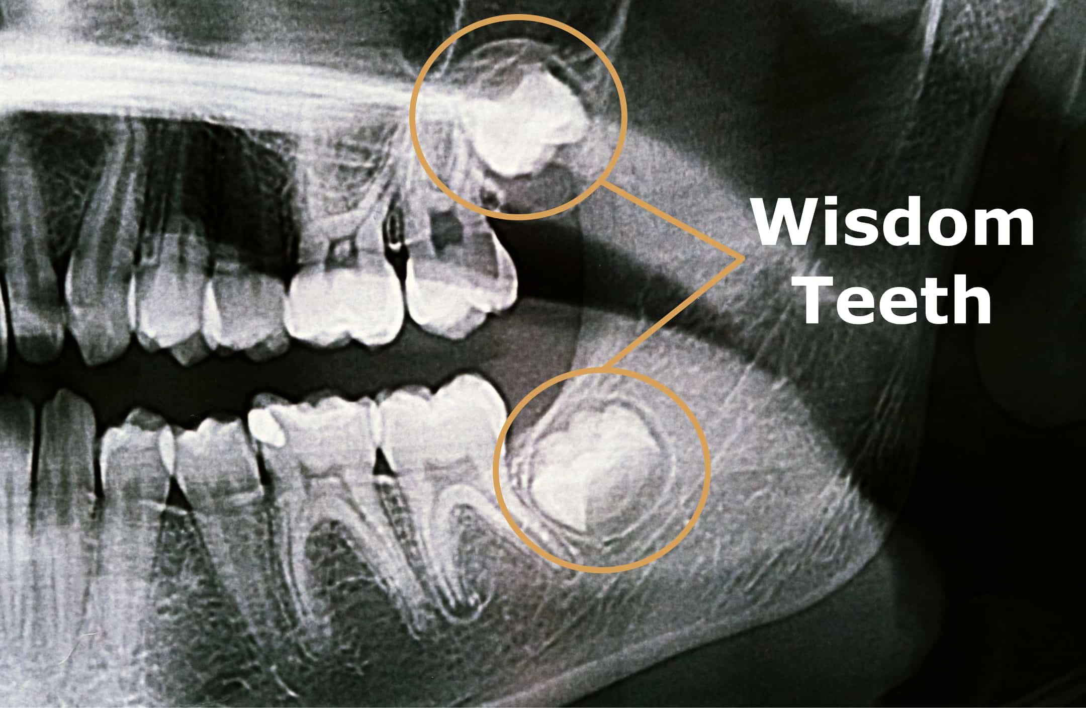 Wisdom Teeth Removal: Why Summer Break Beats the School Year